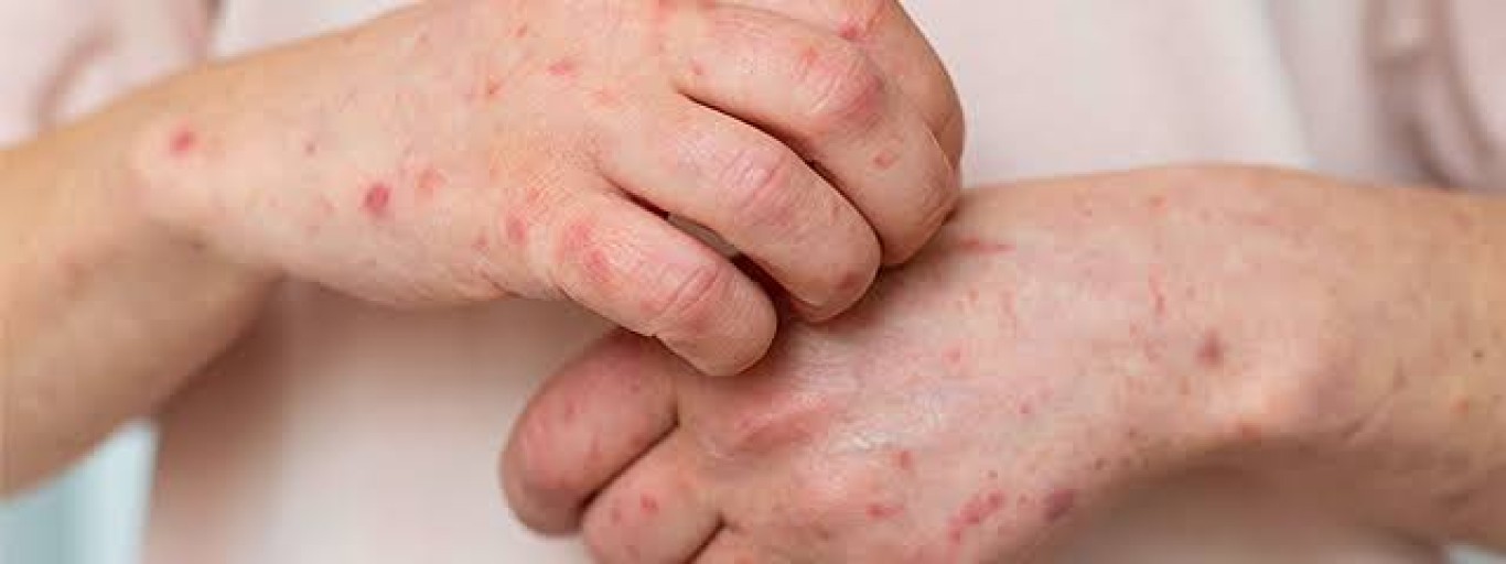Infectologista do HMS reforça cuidados e tranquiliza população sobre Mpox